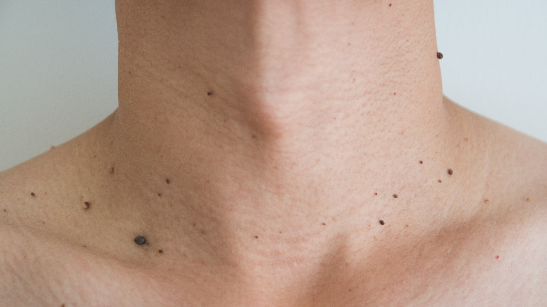 Skin tag removal Limerick